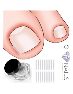 Correzione Unghia Incarnita